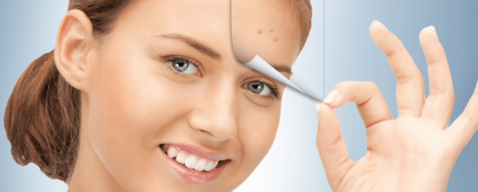 bí quyết trị mụn đầu đen